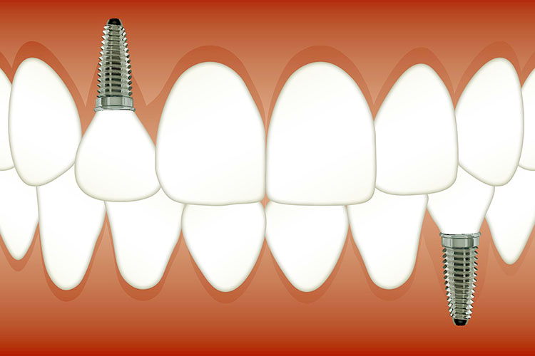 implanty ciekawostki historia zęby dentysta ortodoncja